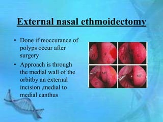 External nasal ethmoidectomy
• Done if reoccurance of
  polyps occur after
  surgery
• Approach is through
  the medial wall of the
  orbitby an external
  incision ,medial to
  medial canthus
 