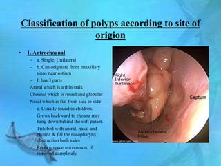Classification of polyps according to site of
                       origion
•    1. Antrochoanal
      – a. Single, Unilateral
      – b. Can originate from maxillary
         sinus near ostium
      – It has 3 parts
      Antral which is a thin stalk
      Choanal which is round and globular
      Nasal which is flat from side to side
      – c. Usually found in children.
      – Grows backward to choana may
         hang down behind the soft palaet.
      – Trilobed with antral, nasal and
         choana & fill the nasopharynx
         obstruction both sides
      – Reoccurrence uncommon, if
         removed completely
 
