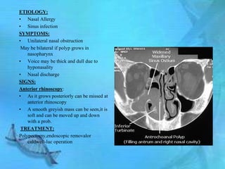ETIOLOGY:
• Nasal Allergy
• Sinus infection
SYMPTOMS:
• Unilateral nasal obstruction
 May be bilateral if polyp grows in
    nasopharynx
• Voice may be thick and dull due to
    hyponasality
• Nasal discharge
SIGNS:
Anterior rhinoscopy:
• As it grows posteriorly can be missed at
    anterior rhinoscopy
• A smooth greyish mass can be seen,it is
    soft and can be moved up and down
    with a prob.
 TREATMENT:
Polypectomy,endoscopic removalor
    caldwell-luc operation
 
