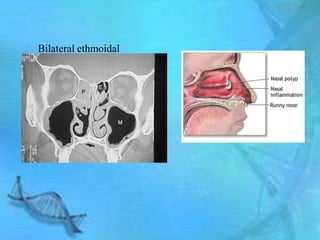 Bilateral ethmoidal
 