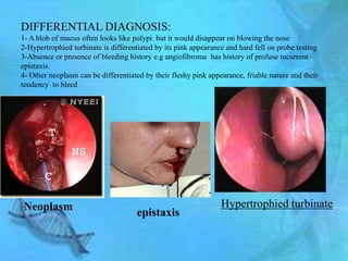 DIFFERENTIAL DIAGNOSIS:
1- A blob of mucus often looks like polypi but it would disappear on blowing the nose
2-Hypertrophied turbinate is differentiated by its pink appearance and hard fell on probe testing
3-Absence or presence of bleeding history e.g angiofibroma has history of profuse recurrent
epistaxis.
4- Other neoplasm can be differentiated by their fleshy pink appearance, friable nature and their
tendency to bleed




Neoplasm                                                         Hypertrophied turbinate
                                     epistaxis
 