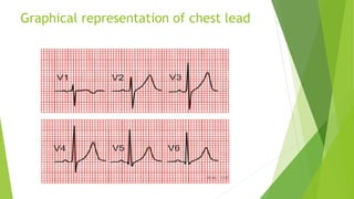Graphical representation of chest lead
 