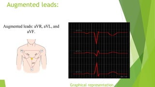 Augmented leads:
Graphical representation
 