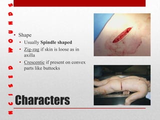 Characters
• Shape
• Usually Spindle shaped
• Zig-zag if skin is loose as in
axilla
• Crescentic if present on convex
parts like buttocks
 