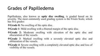 Grades of Papilledema
Papilledema, also known as optic disc swelling, is graded based on its
severity. The most commonly used grading system is the Frisén Scale, which
has five grades:
Grade 0: No swelling of the optic disc.
Grade 1: Mild swelling with a blurred margin of the optic disc.
Grade 2: Moderate swelling with elevation of the optic disc and
obscuration of the vessels.
Grade 3: Marked swelling with a severely elevated optic disc and
obliteration of the vessels.
Grade 4: Severe swelling with a completely elevated optic disc and loss of
visibility of the vessels.
 
