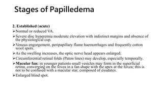 Stages of Papilledema
2. Established (acute)
Normal or reduced VA.
Severe disc hyperemia moderate elevation with indistinct margins and absence of
the physiological cup.
Venous engorgement, peripapillary flame haemorrhages and frequently cotton
wool spots.
As the swelling increases, the optic nerve head appears enlarged.
Circumferential retinal folds (Paton lines) may develop, especially temporally.
Macular fan: in younger patients small vesicles may form in the superficial
retina, converging on the fovea in a fan shape with the apex at the fovea; this is
not to be confused with a macular star, composed of exudates.
Enlarged blind spot.
 