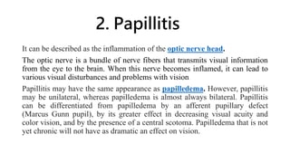 2. Papillitis
It can be described as the inflammation of the optic nerve head.
The optic nerve is a bundle of nerve fibers that transmits visual information
from the eye to the brain. When this nerve becomes inflamed, it can lead to
various visual disturbances and problems with vision.
Papillitis may have the same appearance as papilledema. However, papillitis
may be unilateral, whereas papilledema is almost always bilateral. Papillitis
can be differentiated from papilledema by an afferent pupillary defect
(Marcus Gunn pupil), by its greater effect in decreasing visual acuity and
color vision, and by the presence of a central scotoma. Papilledema that is not
yet chronic will not have as dramatic an effect on vision.
 