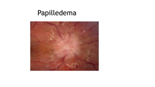 Papilledema
 