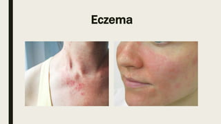 Eczema
 