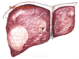 Walls of
scar
tissue
begin to
form
Healthy liver cells
become trapped
by a wall of scar
tissuewww.pharmacyhighlights.com
 
