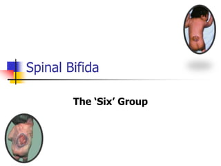 Spinal Bifida
The ‘Six’ Group
 