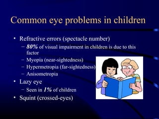 Common eye problems in children
• Refractive errors (spectacle number)
– 80% of visual impairment in children is due to this
factor
– Myopia (near-sightedness)
– Hypermetropia (far-sightedness)
– Anisometropia
• Lazy eye
– Seen in 1% of children
• Squint (crossed-eyes)
 