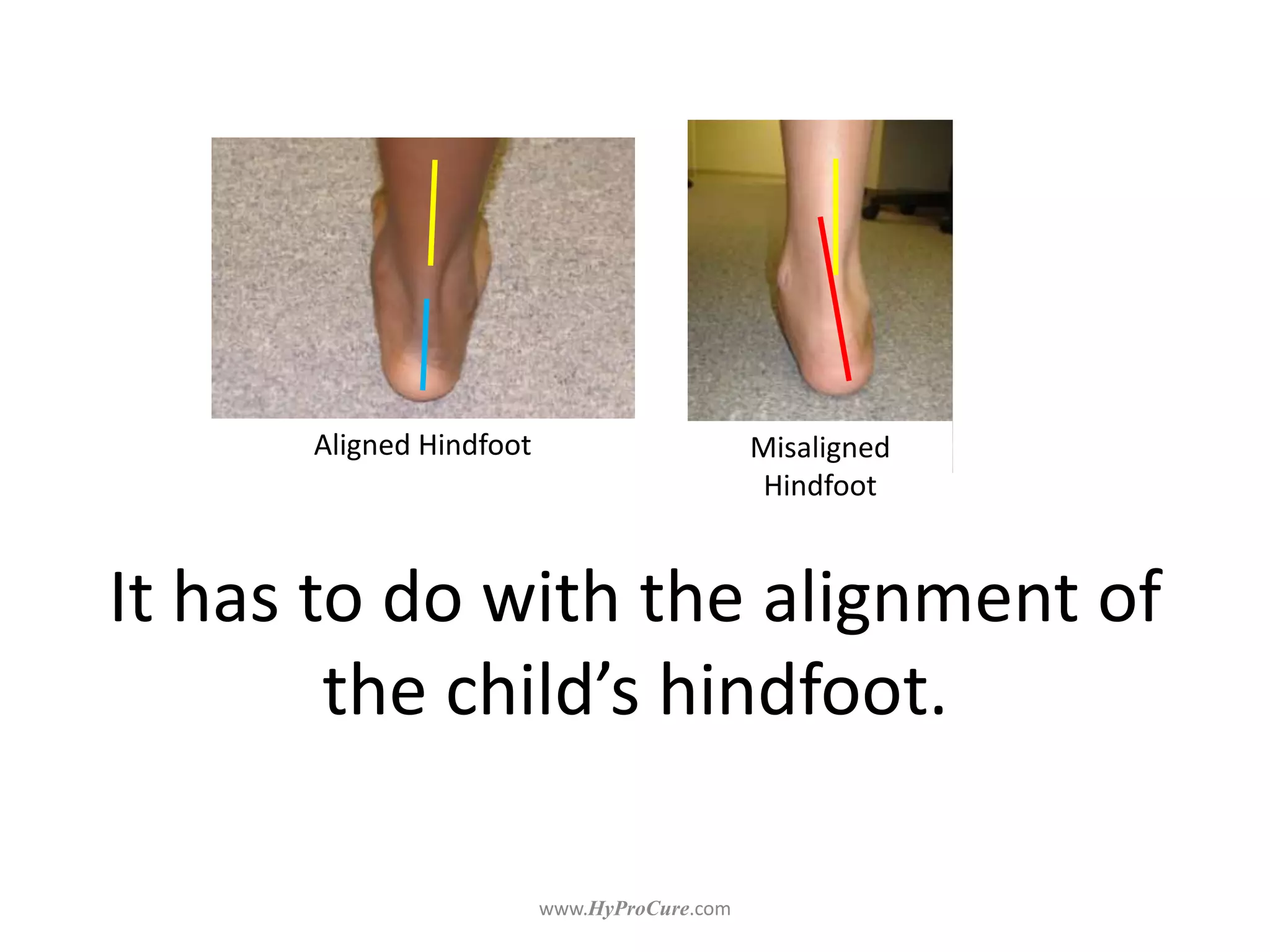It has to do with the alignment of
the child’s hindfoot.
Aligned Hindfoot Misaligned
Hindfoot
 