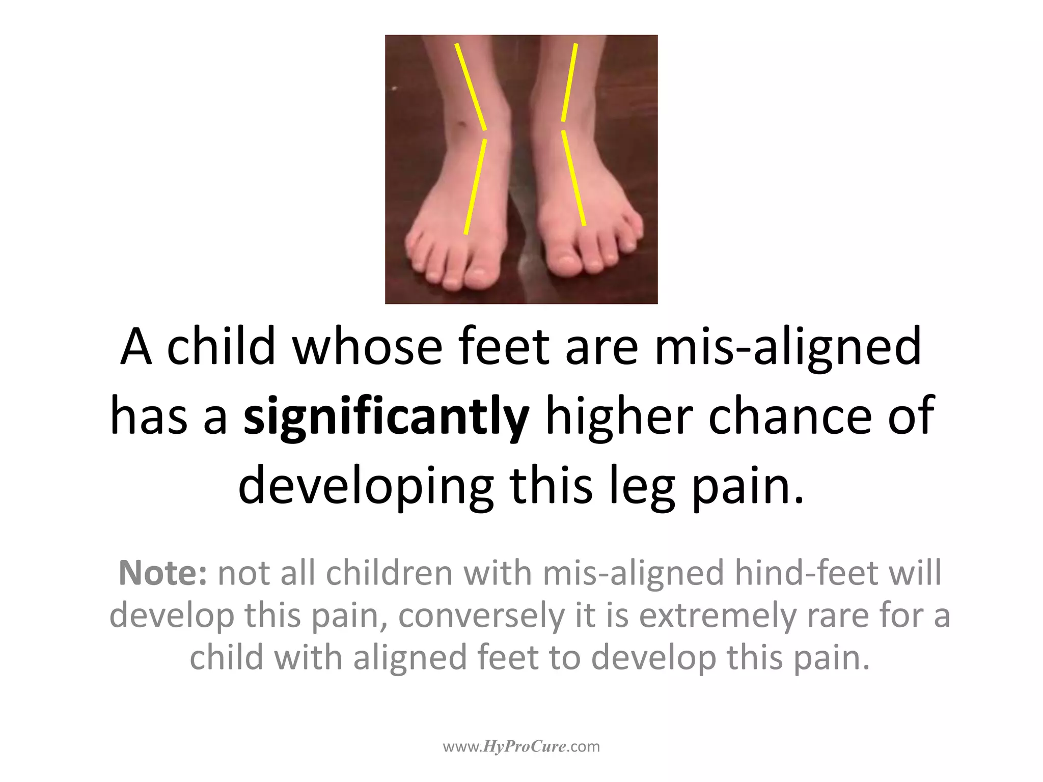 A child whose feet are mis-aligned
has a significantly higher chance of
developing this leg pain.
Note: not all children with mis-aligned hind-feet will
develop this pain, conversely it is extremely rare for a
child with aligned feet to develop this pain.
 