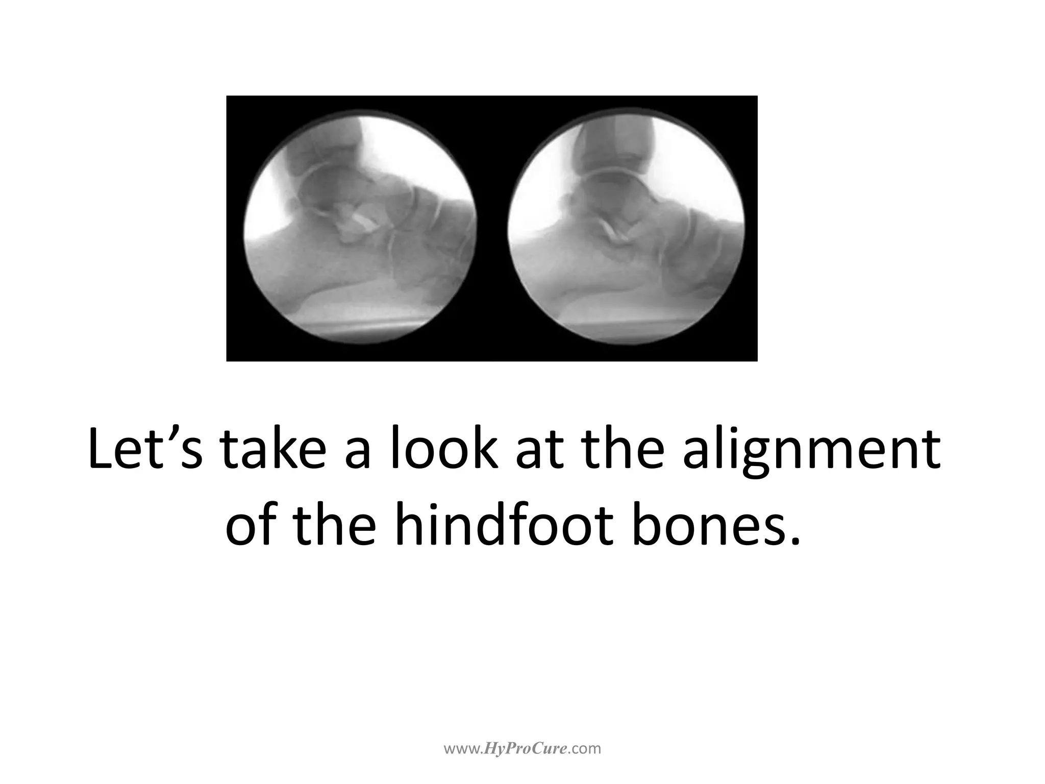 Let’s take a look at the alignment
of the hindfoot bones.
 