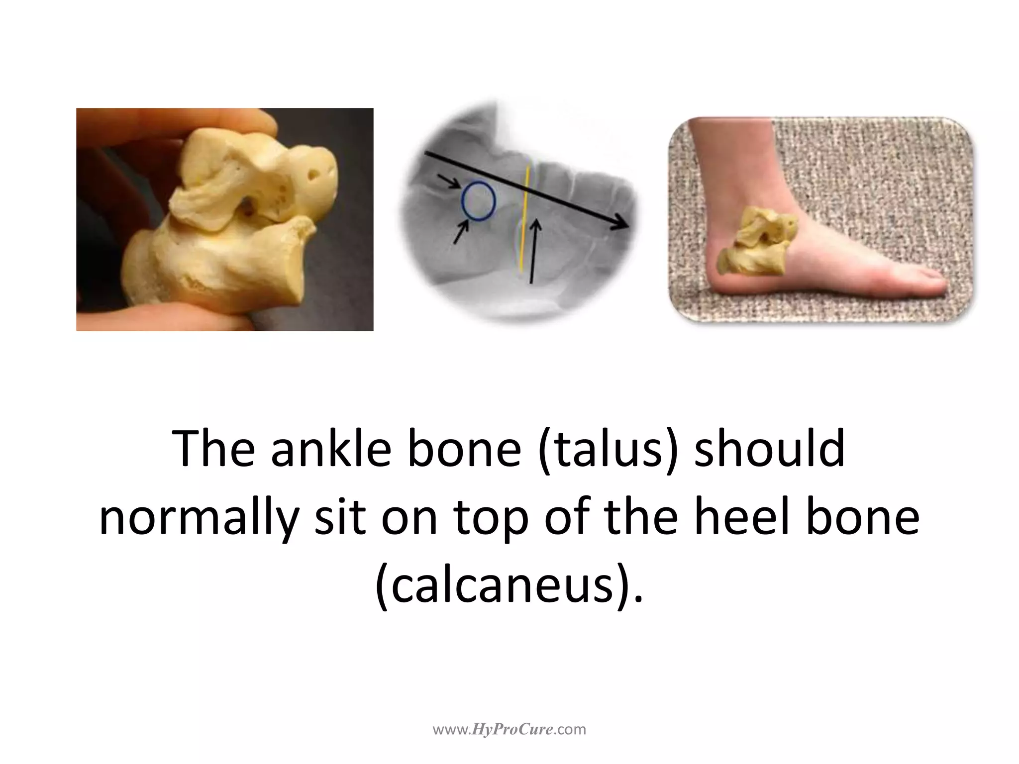 The ankle bone (talus) should
normally sit on top of the heel bone
(calcaneus).
 