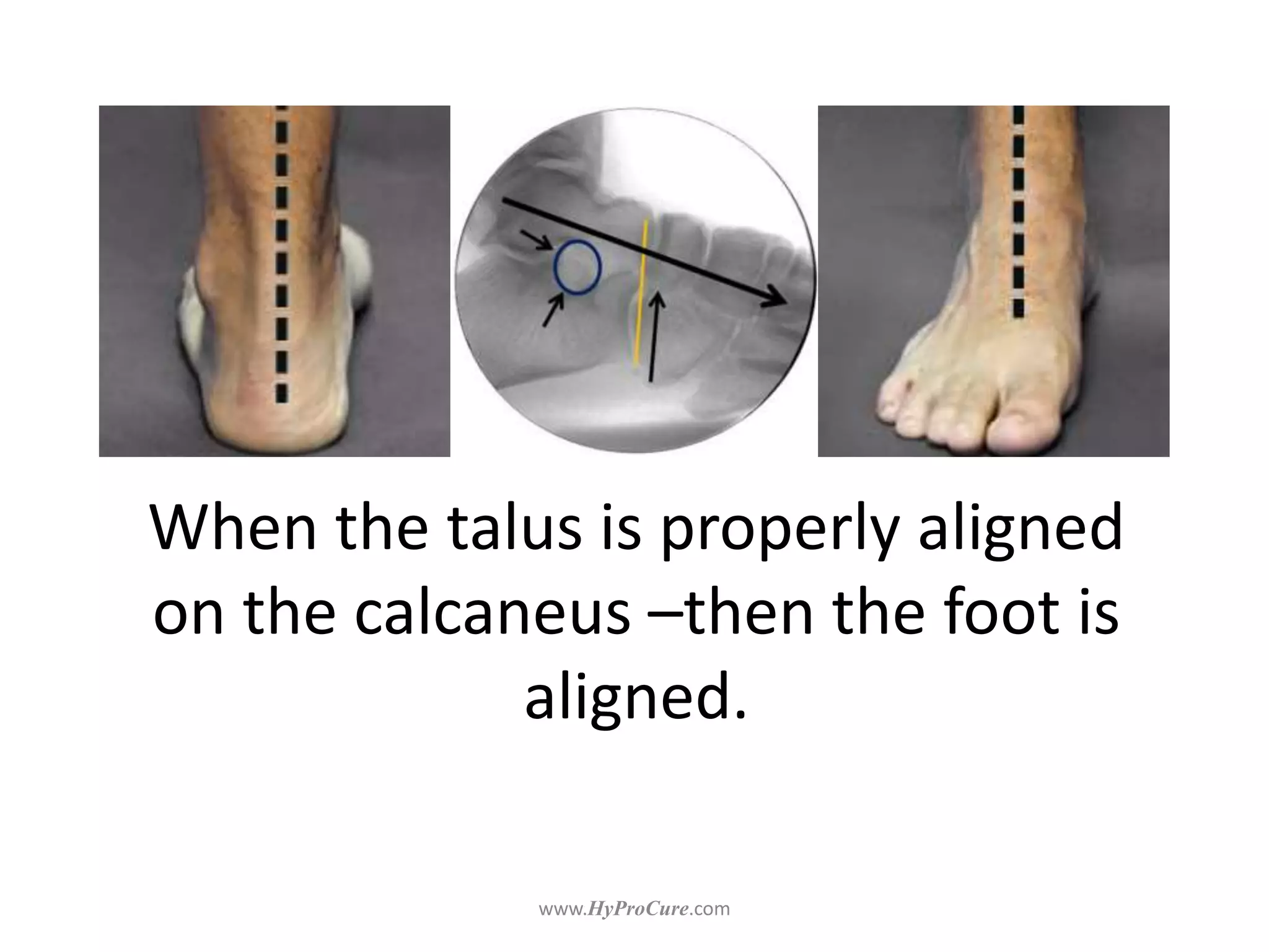 When the talus is properly aligned
on the calcaneus –then the foot is
aligned.
 