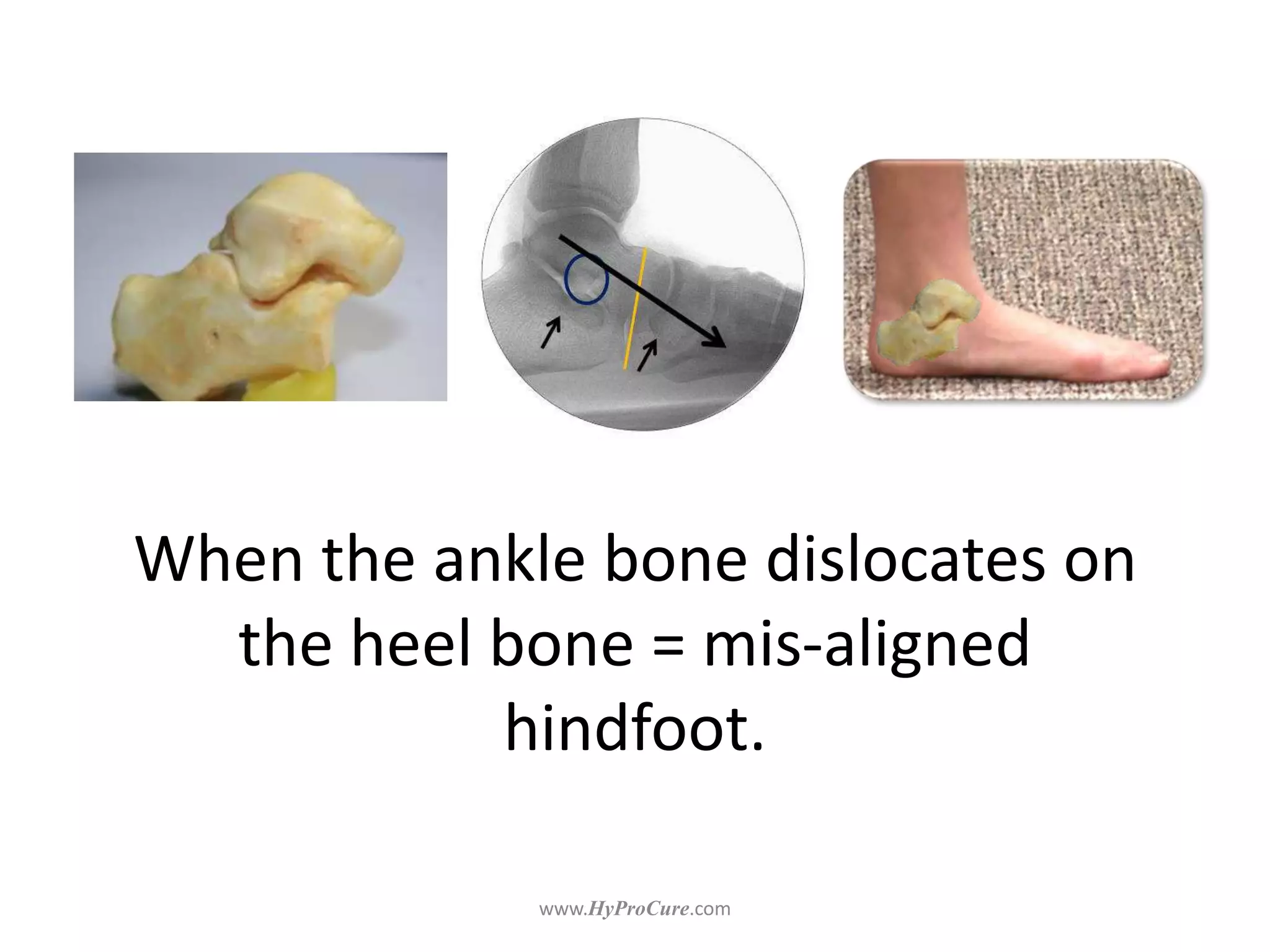 When the ankle bone dislocates on
the heel bone = mis-aligned
hindfoot.
 