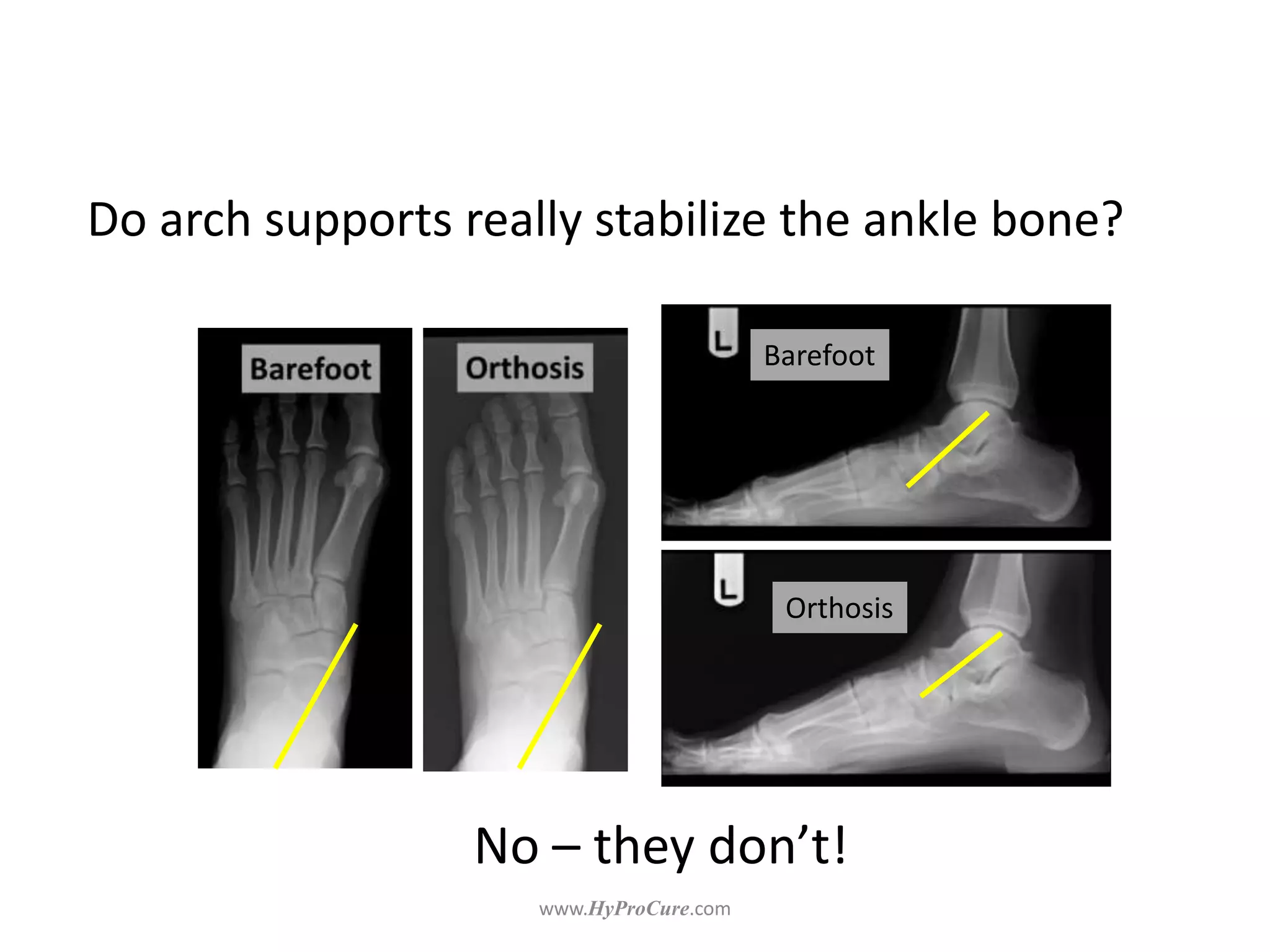 Do arch supports really stabilize the ankle bone?
Barefoot
Orthosis
 