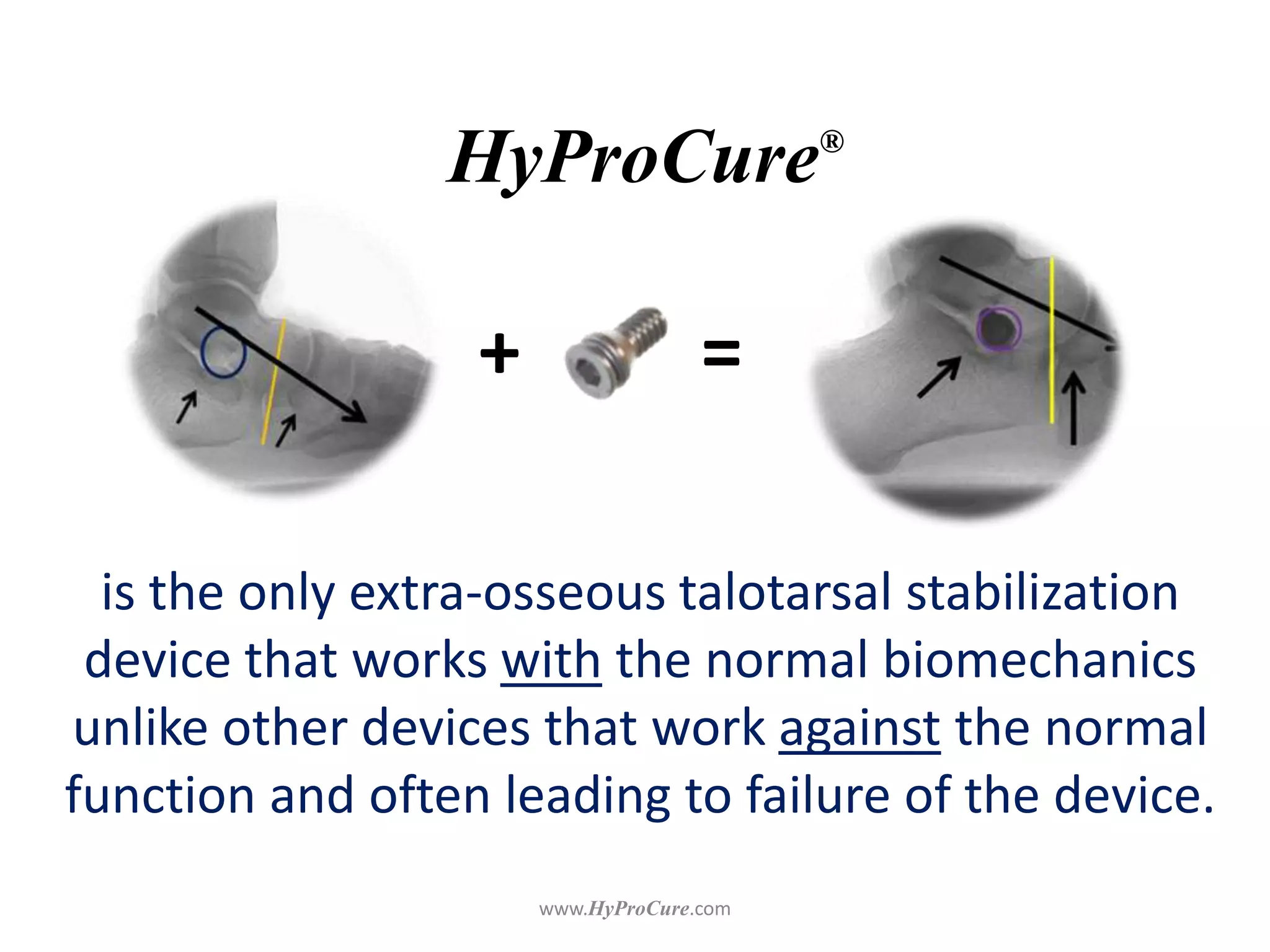 HyProCure®
is the only extra-osseous talotarsal stabilization
device that works with the normal
biomechanics unlike other devices that work
against the normal function and often leading
to failure of the device.
+ =
 