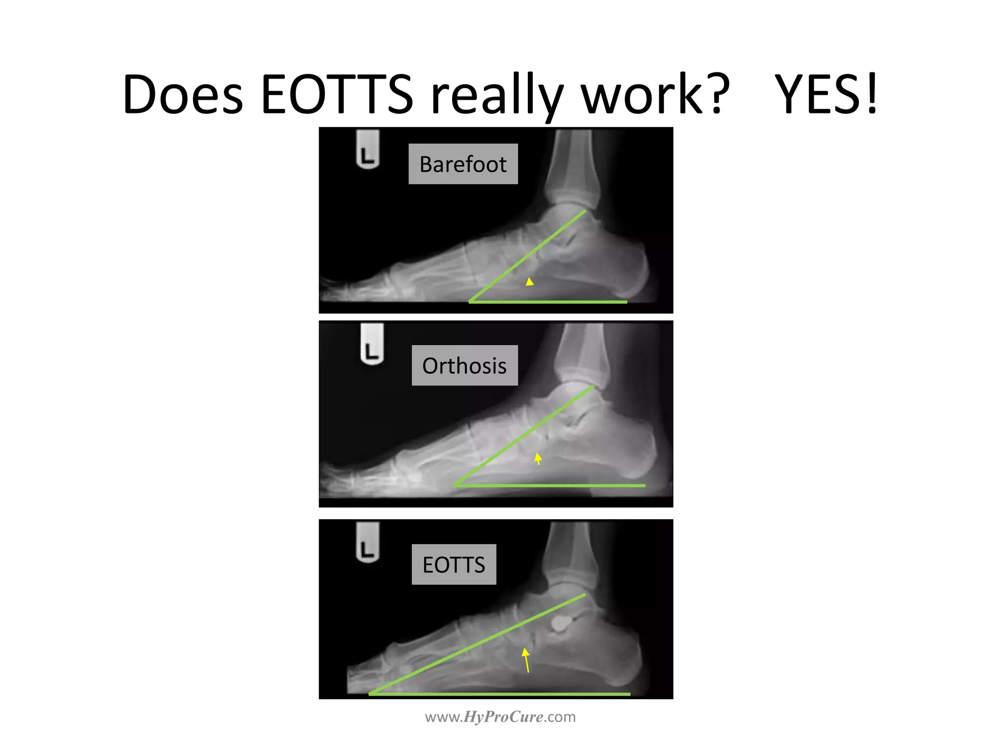 Does EOTTS really work? YES!
Barefoot
Orthosis
EOTTS
 