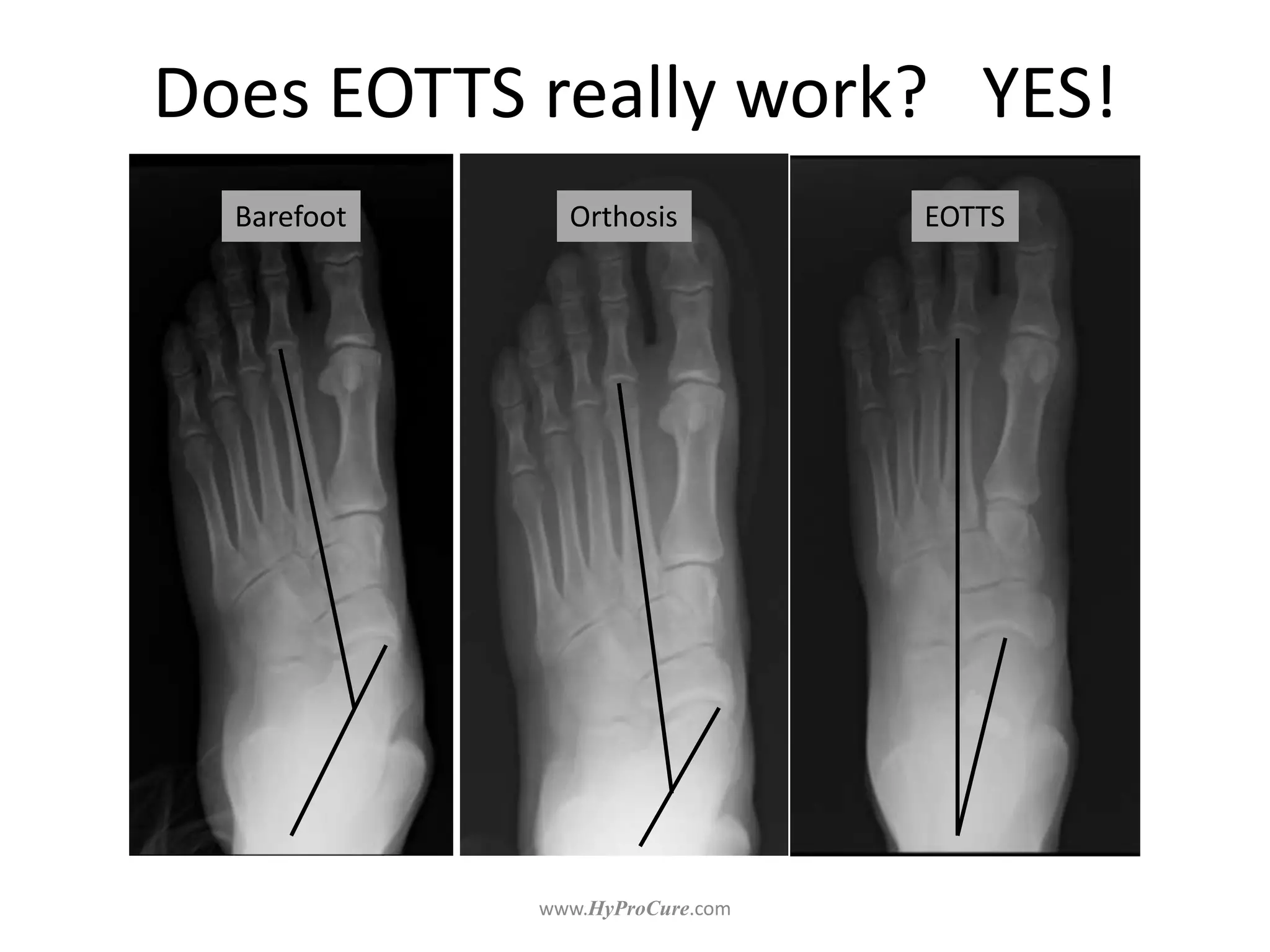 Barefoot Orthosis EOTTS
Does EOTTS really work? YES!
 
