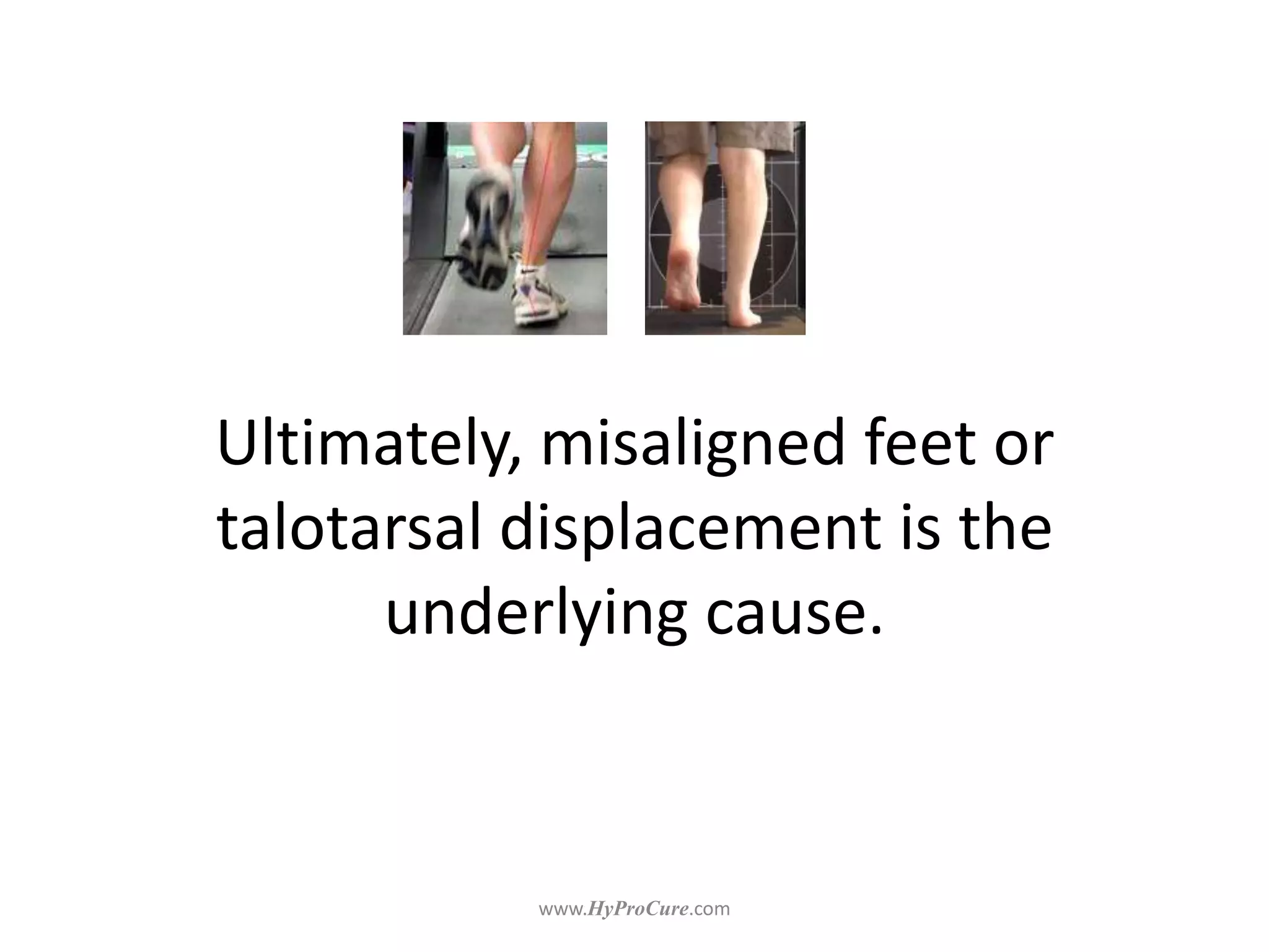 Ultimately, misaligned feet or
talotarsal displacement is the
underlying cause.
 