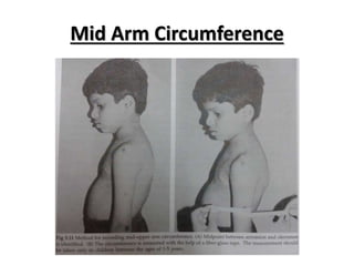 Mid Arm Circumference
 
