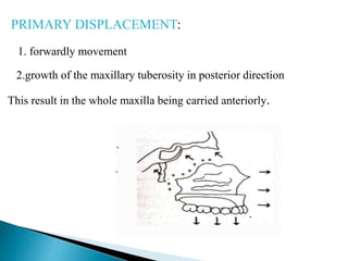 PRIMARY DISPLACEMENT:
1. forwardly movement
2.growth of the maxillary tuberosity in posterior direction
This result in the whole maxilla being carried anteriorly.
 