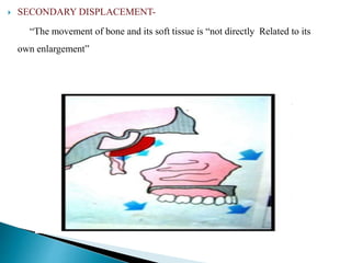  SECONDARY DISPLACEMENT-
“The movement of bone and its soft tissue is “not directly Related to its
own enlargement”
 