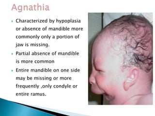  Characterized by hypoplasia
or absence of mandible more
commonly only a portion of
jaw is missing.
 Partial absence of mandible
is more common
 Entire mandible on one side
may be missing or more
frequently ,only condyle or
entire ramus.
 