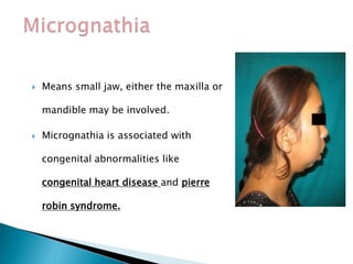  Means small jaw, either the maxilla or
mandible may be involved.
 Micrognathia is associated with
congenital abnormalities like
congenital heart disease and pierre
robin syndrome.
 