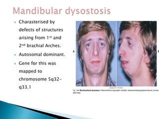  Charasterised by
defects of structures
arising from 1st and
2nd brachial Arches.
 Autosomal dominant.
 Gene for this was
mapped to
chromosome 5q32-
q33.1
 