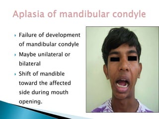 Failure of development
of mandibular condyle
 Maybe unilateral or
bilateral
 Shift of mandible
toward the affected
side during mouth
opening.
 