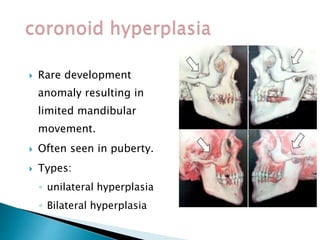  Rare development
anomaly resulting in
limited mandibular
movement.
 Often seen in puberty.
 Types:
◦ unilateral hyperplasia
◦ Bilateral hyperplasia
 