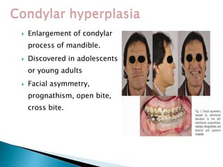  Enlargement of condylar
process of mandible.
 Discovered in adolescents
or young adults
 Facial asymmetry,
prognathism, open bite,
cross bite.
 