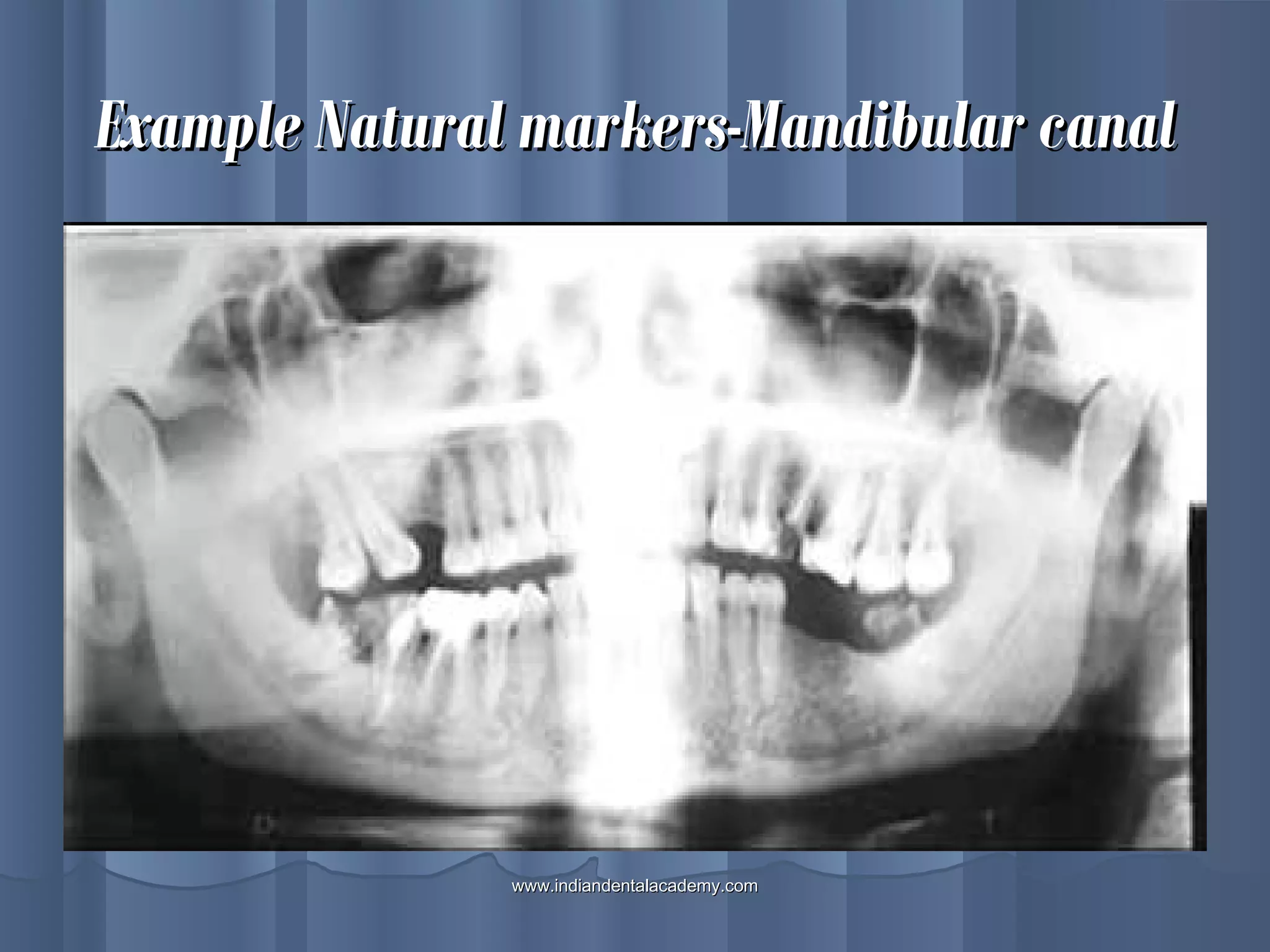 Example Natural markers-Mandibular canalExample Natural markers-Mandibular canal
www.indiandentalacademy.comwww.indiandentalacademy.com
 