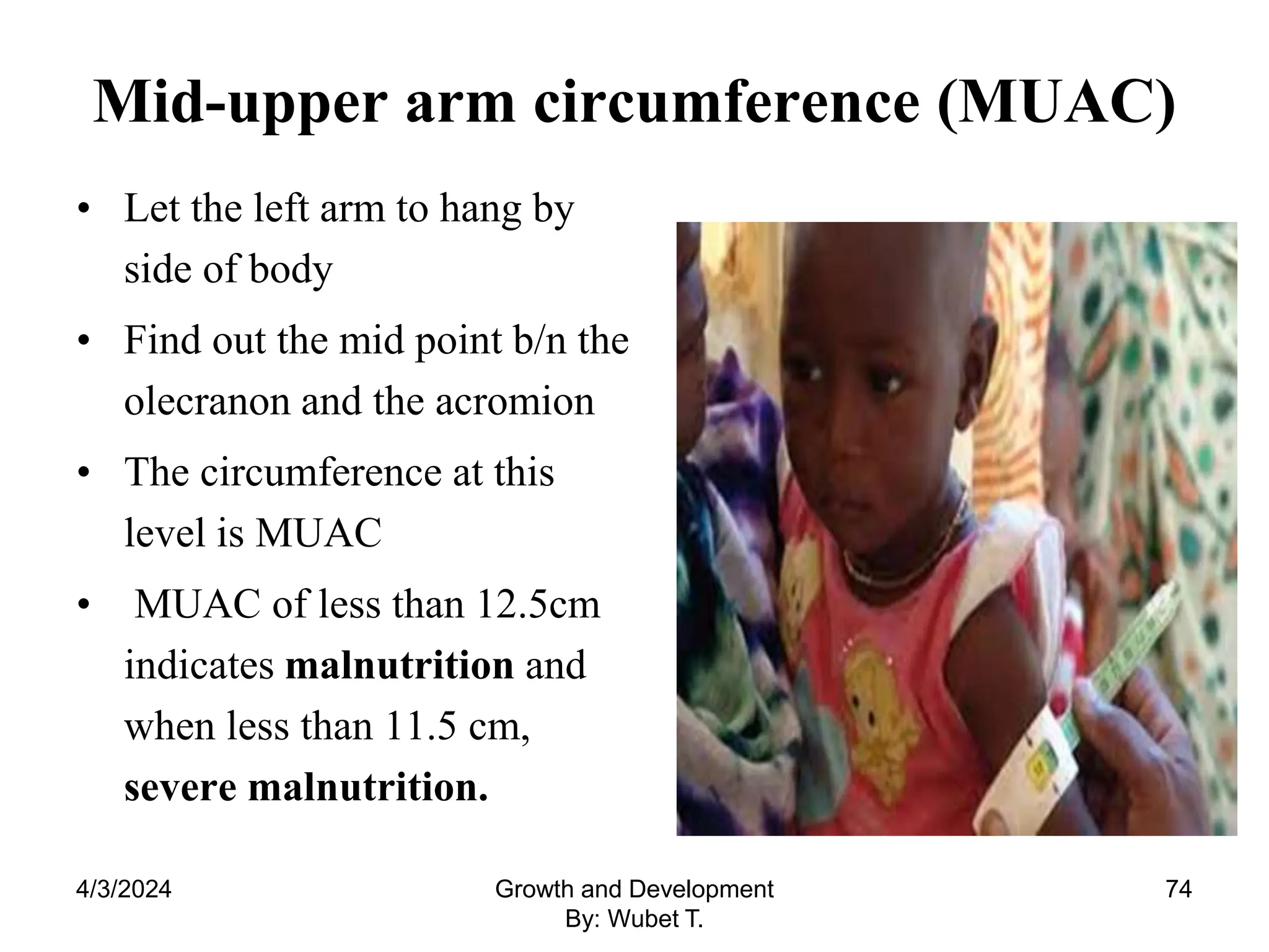Mid-upper arm circumference (MUAC)
• Let the left arm to hang by
side of body
• Find out the mid point b/n the
olecranon and the acromion
• The circumference at this
level is MUAC
• MUAC of less than 12.5cm
indicates malnutrition and
when less than 11.5 cm,
severe malnutrition.
74
4/3/2024 Growth and Development
By: Wubet T.
 