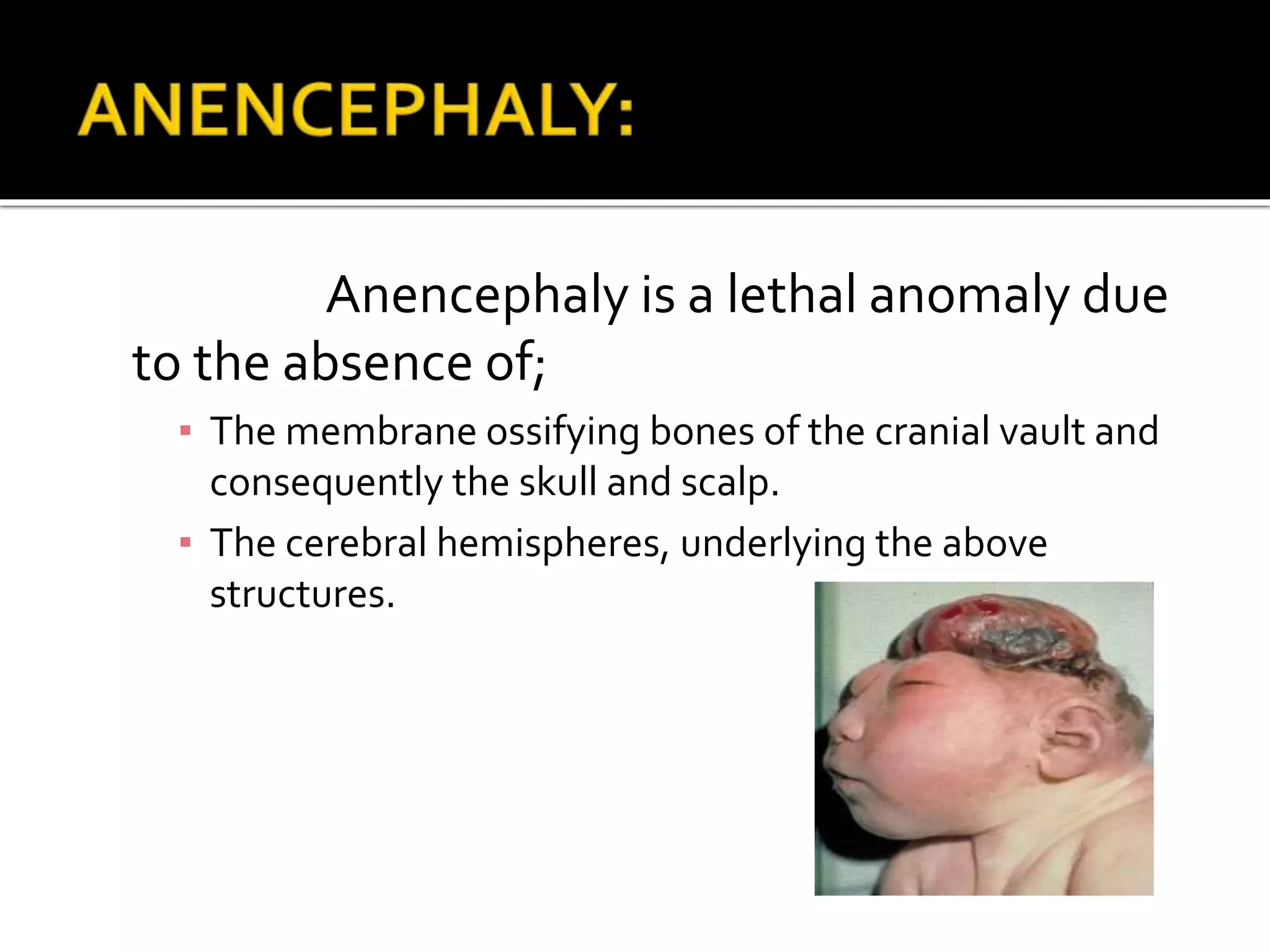 Anencephaly is a lethal anomaly due
to the absence of;
▪ The membrane ossifying bones of the cranial vault and
consequently the skull and scalp.
▪ The cerebral hemispheres, underlying the above
structures.
 