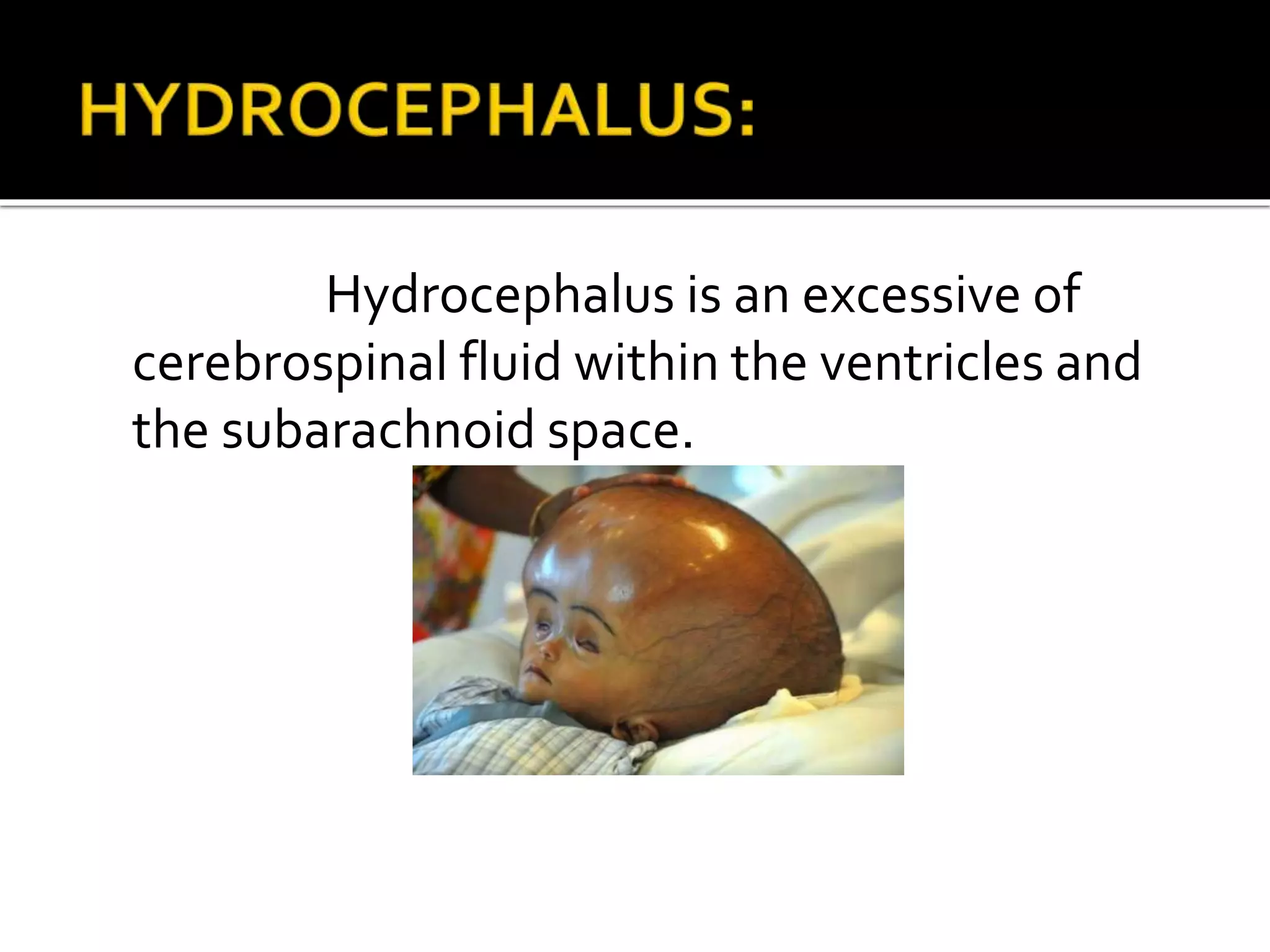 Hydrocephalus is an excessive of
cerebrospinal fluid within the ventricles and
the subarachnoid space.
 