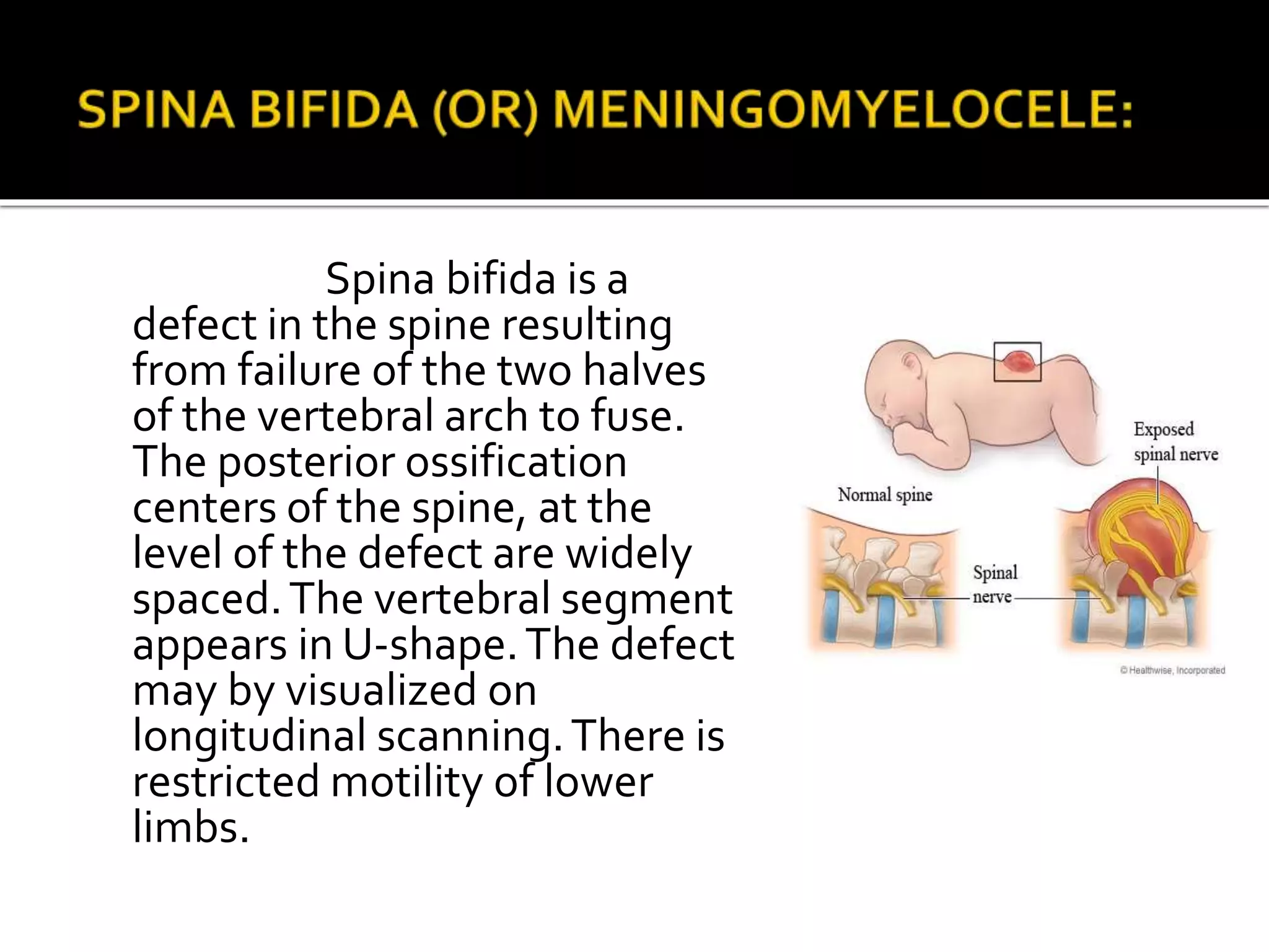 Spina bifida is a
defect in the spine resulting
from failure of the two halves
of the vertebral arch to fuse.
The posterior ossification
centers of the spine, at the
level of the defect are widely
spaced.The vertebral segment
appears in U-shape.The defect
may by visualized on
longitudinal scanning.There is
restricted motility of lower
limbs.
 