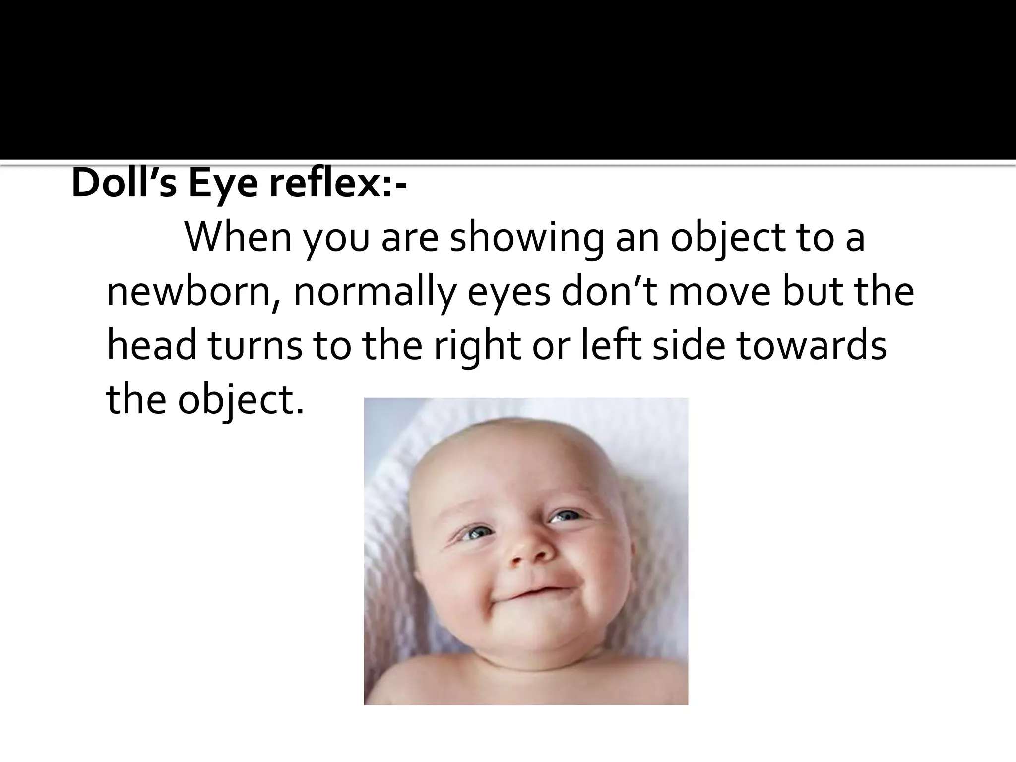 Doll’s Eye reflex:-
When you are showing an object to a
newborn, normally eyes don’t move but the
head turns to the right or left side towards
the object.
 