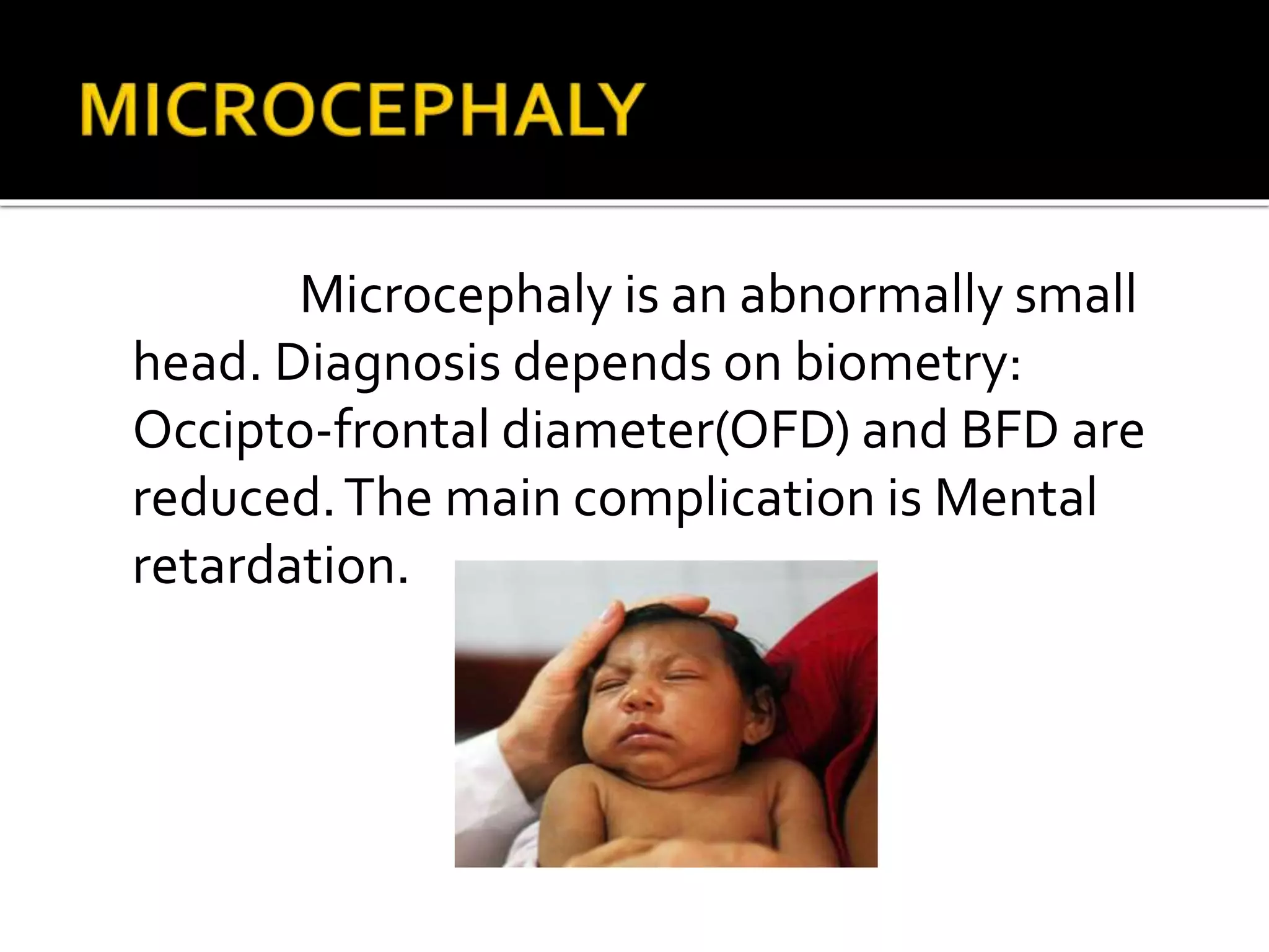 Microcephaly is an abnormally small
head. Diagnosis depends on biometry:
Occipto-frontal diameter(OFD) and BFD are
reduced.The main complication is Mental
retardation.
 