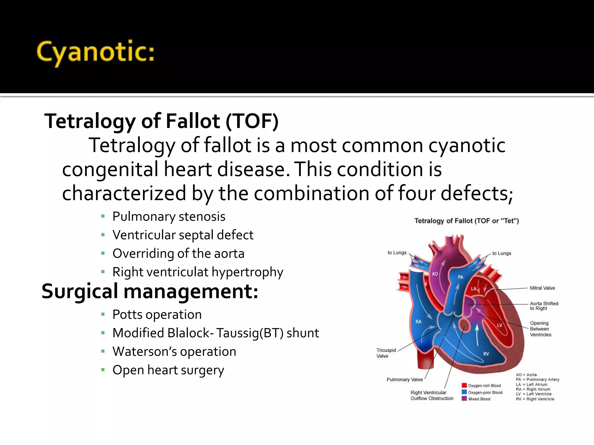 Tetralogy of Fallot (TOF)
Tetralogy of fallot is a most common cyanotic
congenital heart disease.This condition is
characterized by the combination of four defects;
▪ Pulmonary stenosis
▪ Ventricular septal defect
▪ Overriding of the aorta
▪ Right ventriculat hypertrophy
Surgical management:
▪ Potts operation
▪ Modified Blalock-Taussig(BT) shunt
▪ Waterson’s operation
▪ Open heart surgery
 