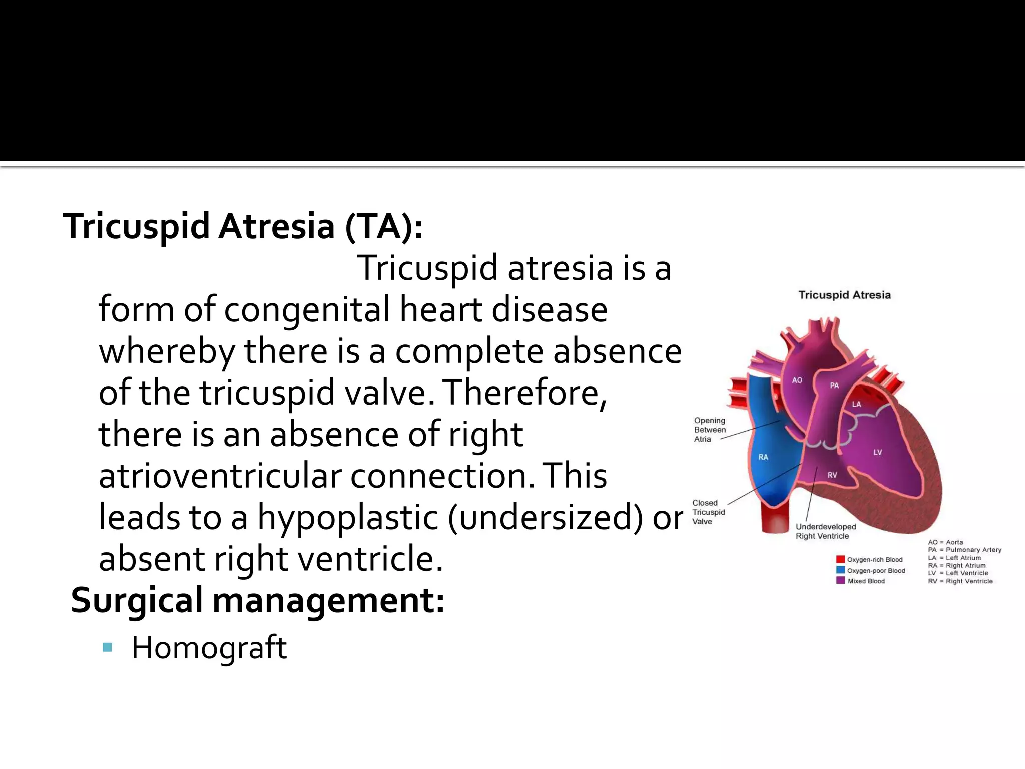Tricuspid Atresia (TA):
Tricuspid atresia is a
form of congenital heart disease
whereby there is a complete absence
of the tricuspid valve.Therefore,
there is an absence of right
atrioventricular connection.This
leads to a hypoplastic (undersized) or
absent right ventricle.
Surgical management:
 Homograft
 