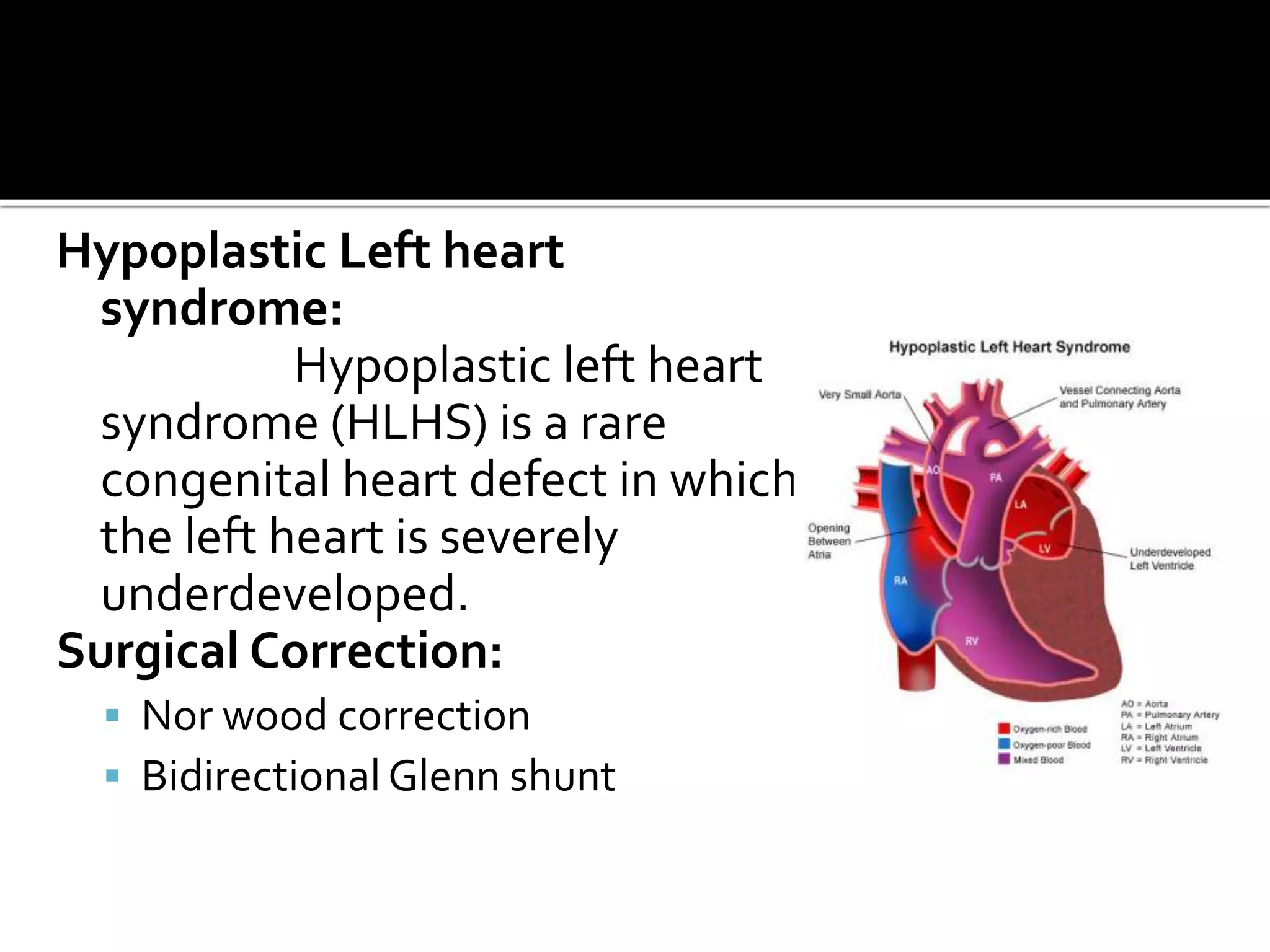 Hypoplastic Left heart
syndrome:
Hypoplastic left heart
syndrome (HLHS) is a rare
congenital heart defect in which
the left heart is severely
underdeveloped.
Surgical Correction:
 Nor wood correction
 Bidirectional Glenn shunt
 