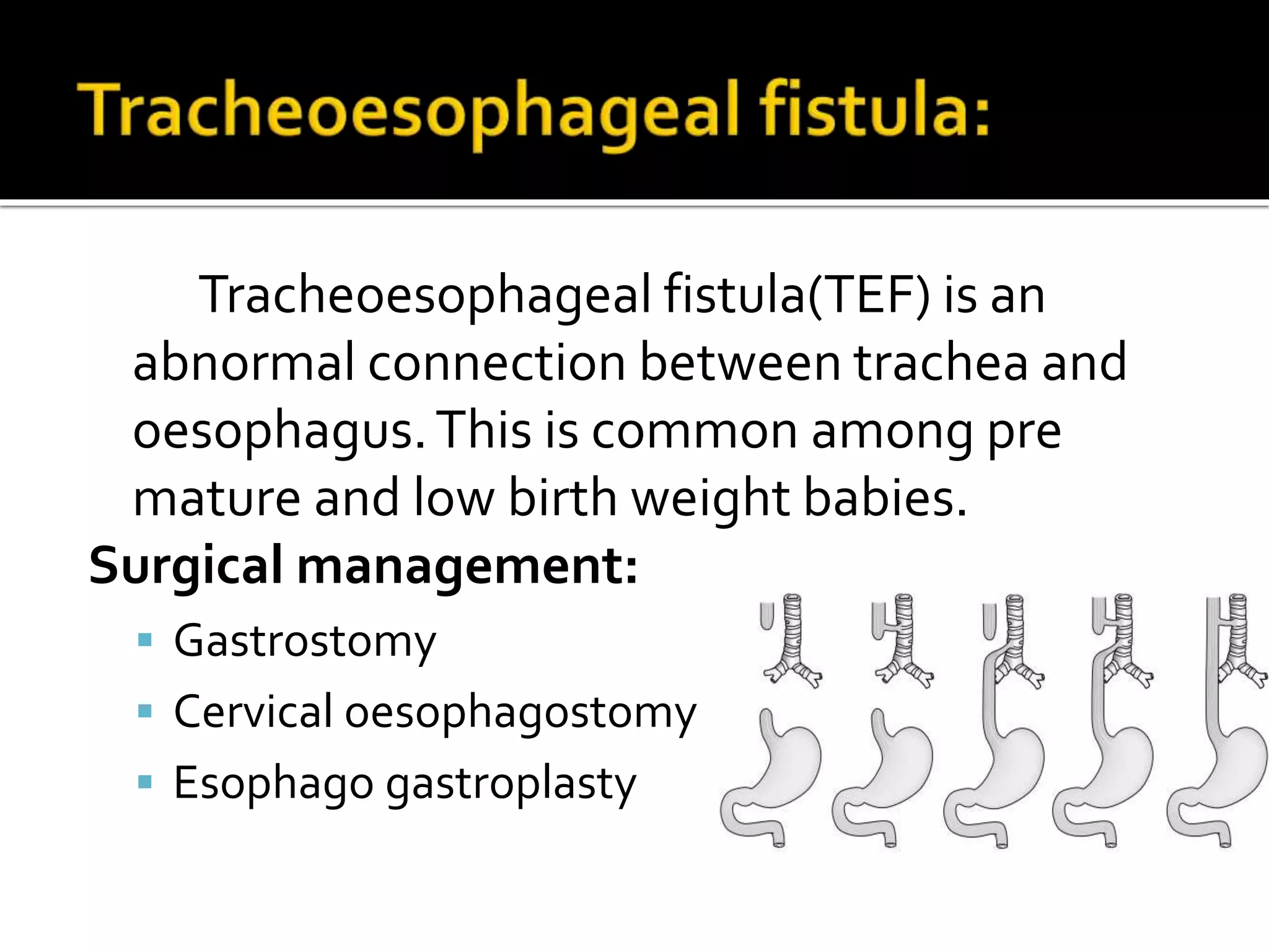 Tracheoesophageal fistula(TEF) is an
abnormal connection between trachea and
oesophagus.This is common among pre
mature and low birth weight babies.
Surgical management:
 Gastrostomy
 Cervical oesophagostomy
 Esophago gastroplasty
 