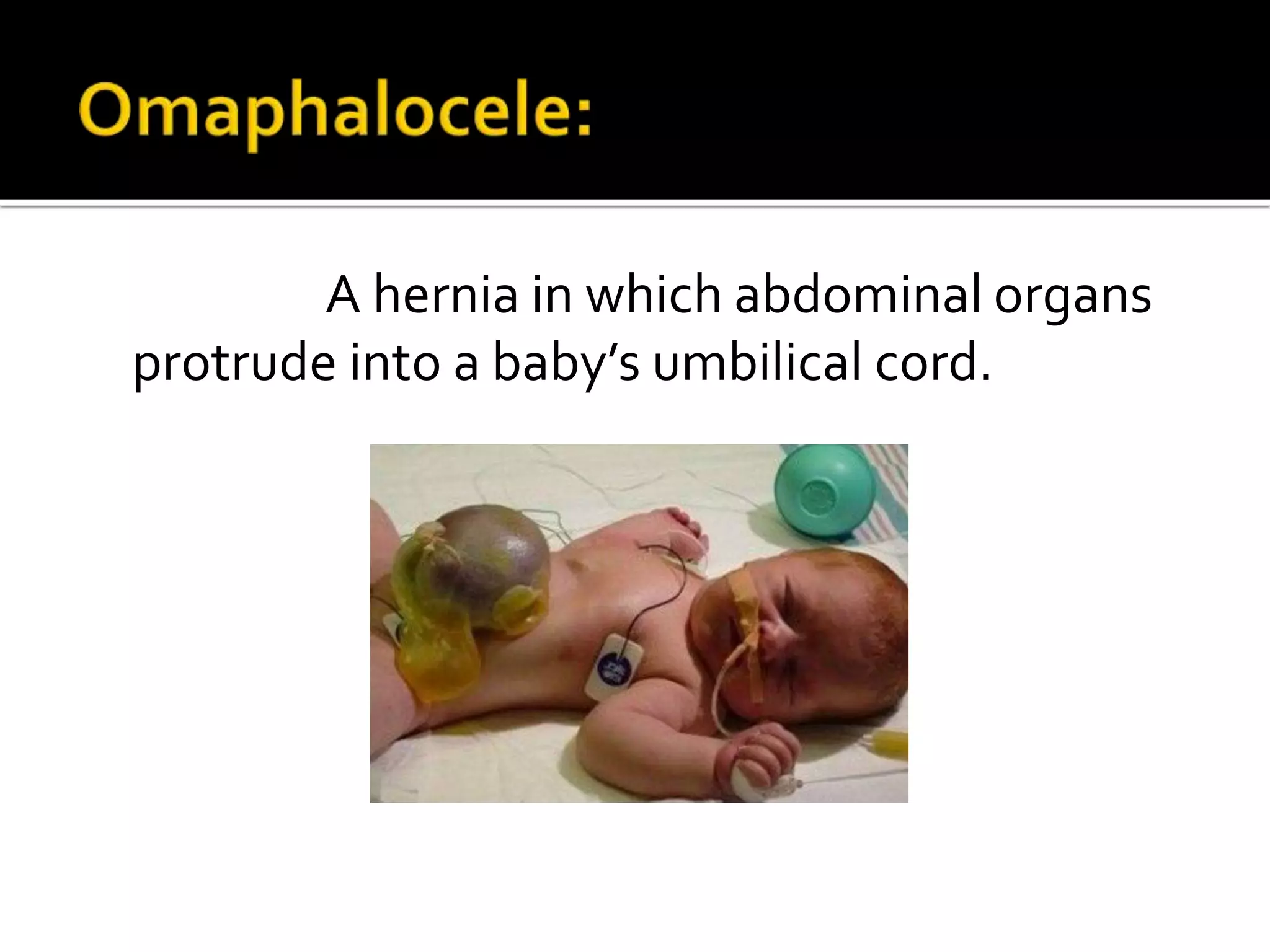 A hernia in which abdominal organs
protrude into a baby’s umbilical cord.
 