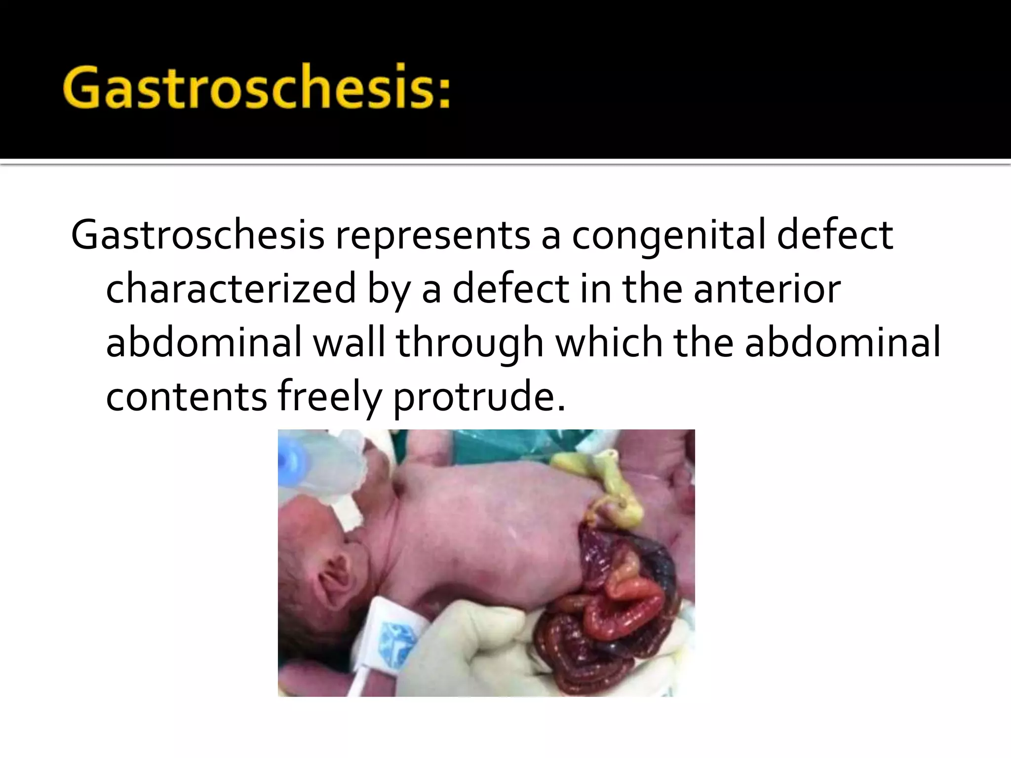 Gastroschesis represents a congenital defect
characterized by a defect in the anterior
abdominal wall through which the abdominal
contents freely protrude.
 