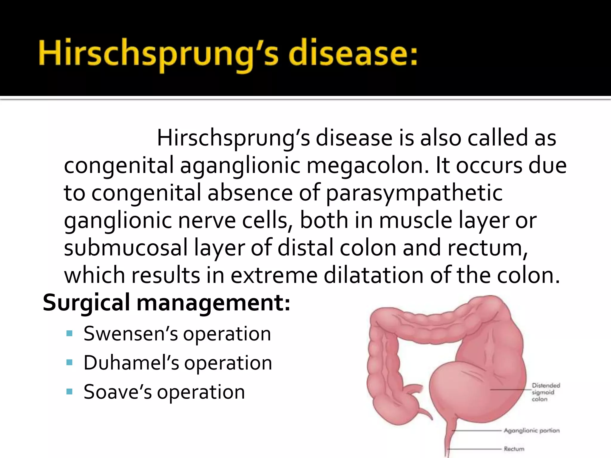 Hirschsprung’s disease is also called as
congenital aganglionic megacolon. It occurs due
to congenital absence of parasympathetic
ganglionic nerve cells, both in muscle layer or
submucosal layer of distal colon and rectum,
which results in extreme dilatation of the colon.
Surgical management:
 Swensen’s operation
 Duhamel’s operation
 Soave’s operation
 